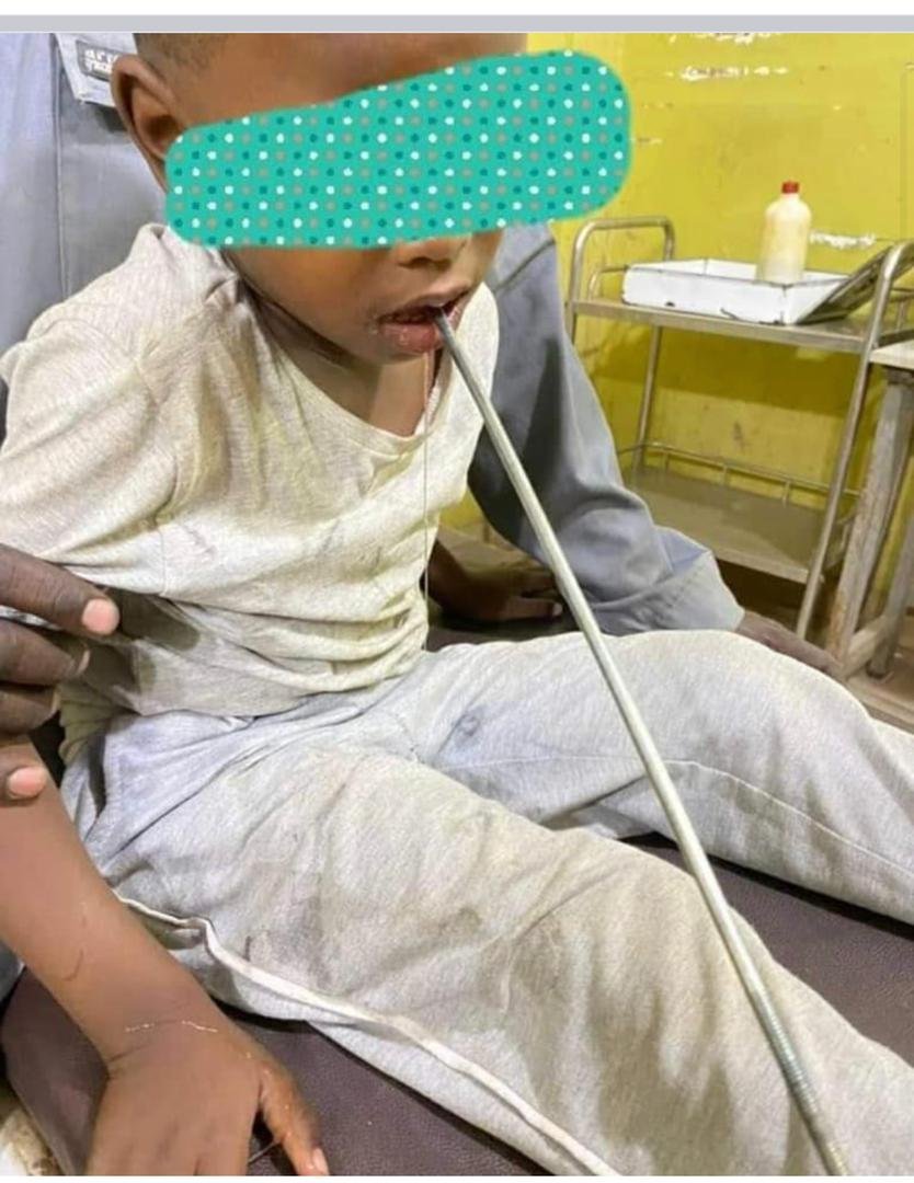 السودان.. أطباء ينقذون طفلاً بإجراء عملية جراحية معقدة واخراج جسم حديدي طوله 16 سنتمترًا(بالصور)