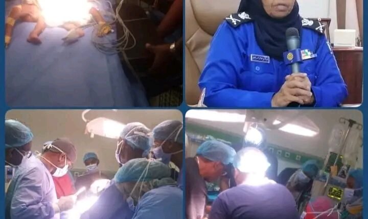 نجاح أول عملية فصل توأم سيامي في السودان بطاقم طبي سوداني