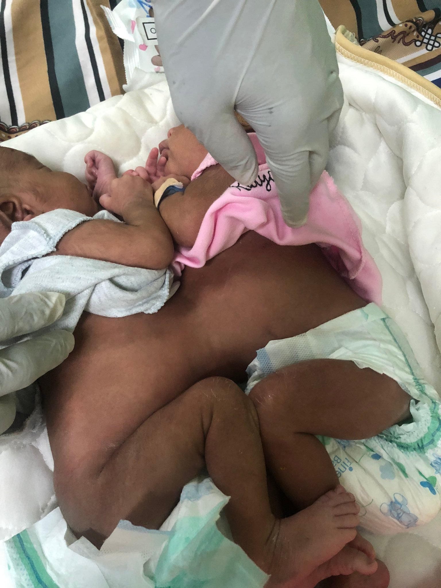 نجاح أول عملية فصل توأم سيامي في السودان بطاقم طبي سوداني