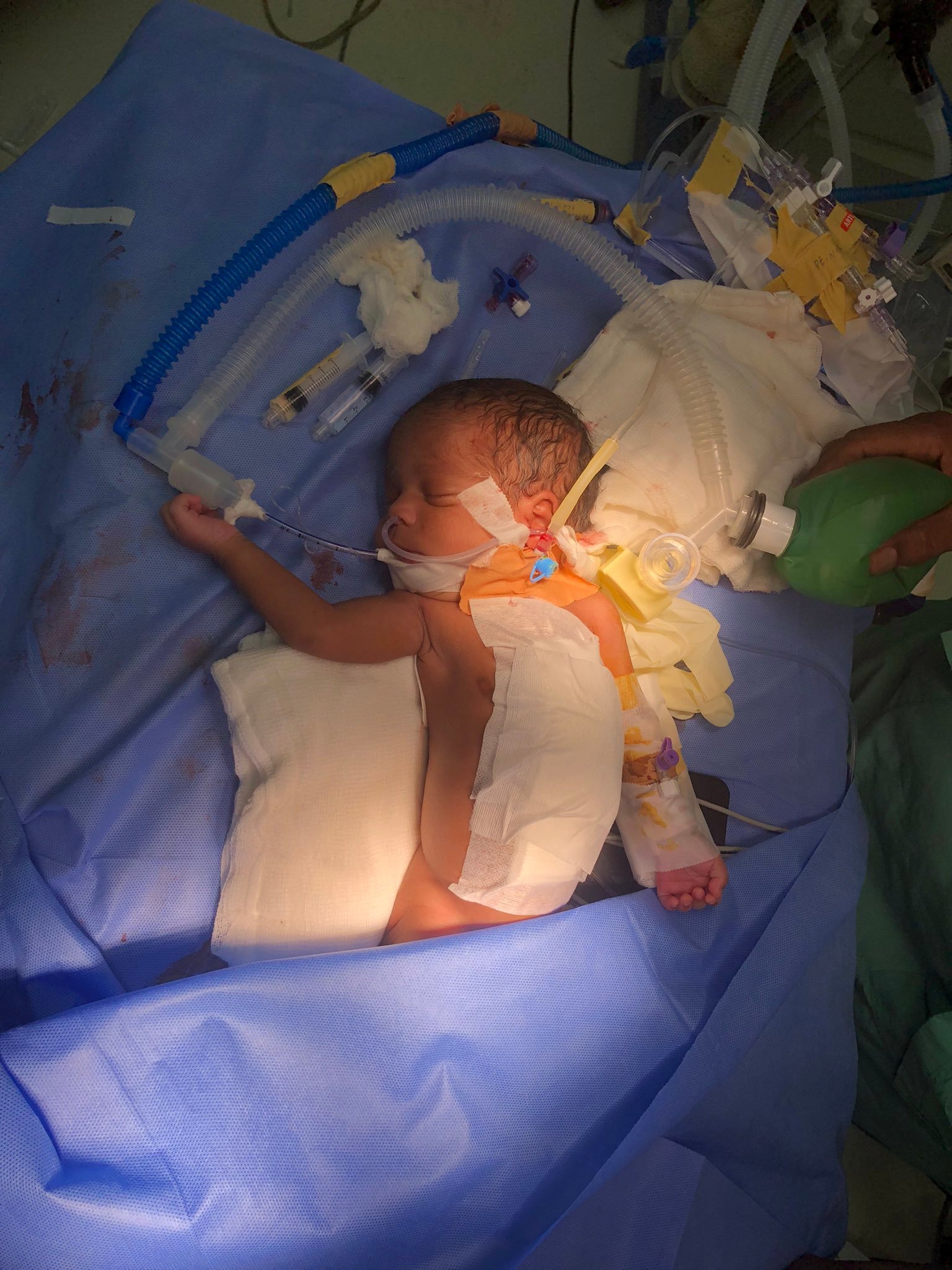 نجاح أول عملية فصل توأم سيامي في السودان بطاقم طبي سوداني