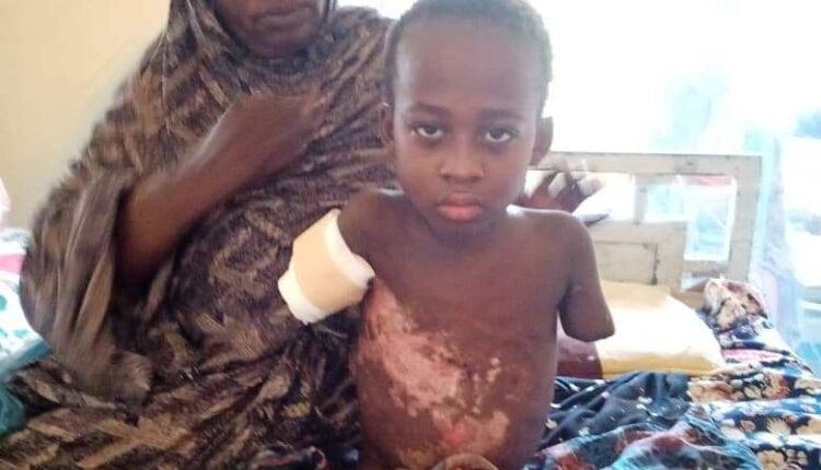 في حادث مأساوي.. طفل سوداني يفقد جميع أطرافه