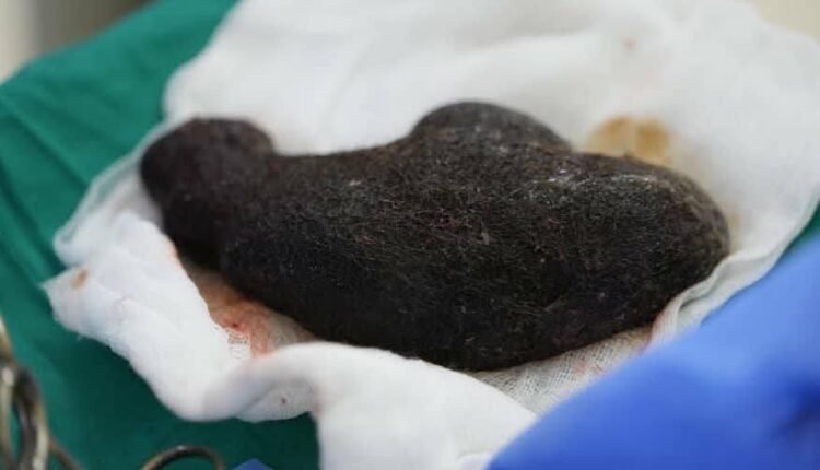 في عملية نادرة: فريق طبي يكتشف مفاجأة داخل معدة طفلة