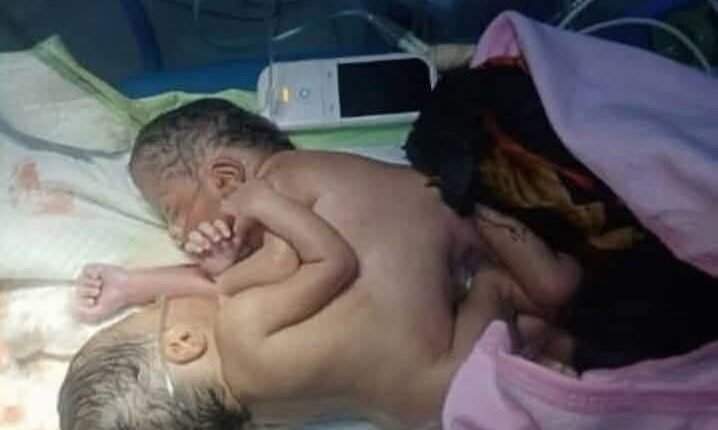 تفاصيل ولادة حالة توأم سيامي نادرة في مدينة ربك