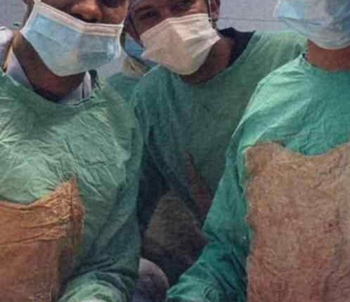 ورم بزنة 5 كيلوغرامات في بطن مريضة