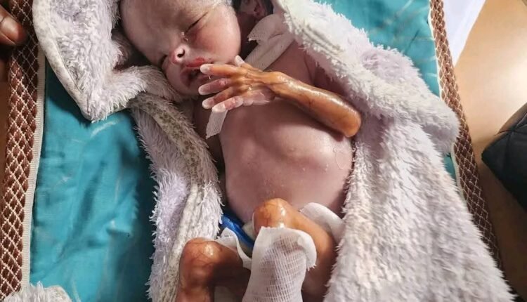 حالة ولادة نادرة.. طفل مصاب بفقدان أجزاء واسعة من جلده