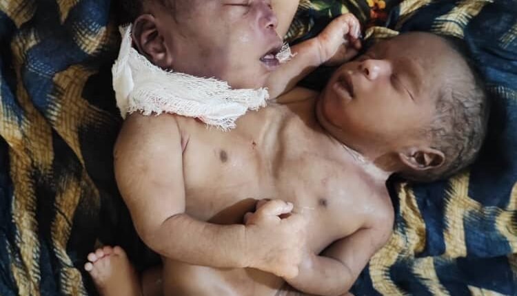 ولادة نادرة لتوأم سيامي في الدبة